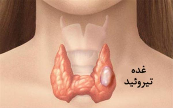 علائم سرطان تیروئید