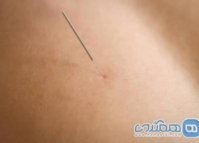 با درای نیدلینگ و کاربرد آن آشنا شوید