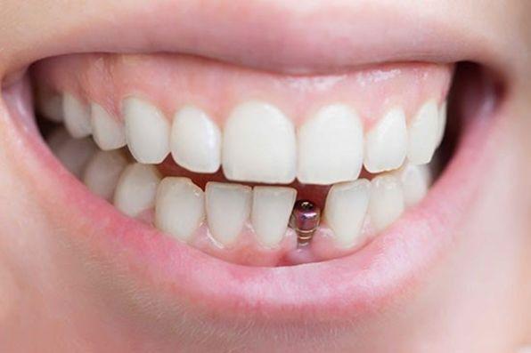 آیا برترین کلینیک کاشت ایمپلنت در تهران را می شناسید؟