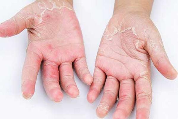 مراقب شایع ترین بیماری های پوستی در نوروز باشید